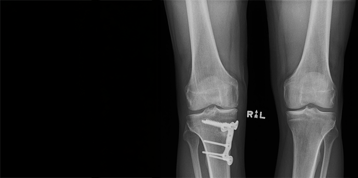 Microbiome and how it affects arthritis